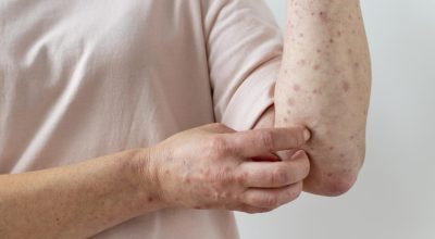 skin-allergy-person-s-arm-1024x681.jpg